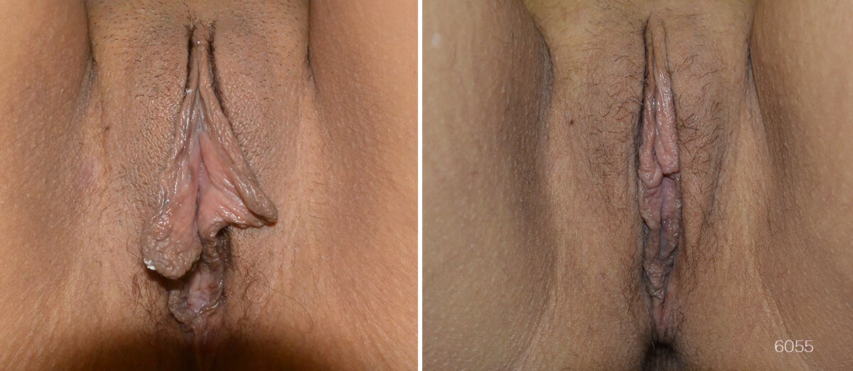 labia reduction surgery price labia reduction surgery price