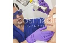 What are the Benefits of Fraxel Laser Treatment?
