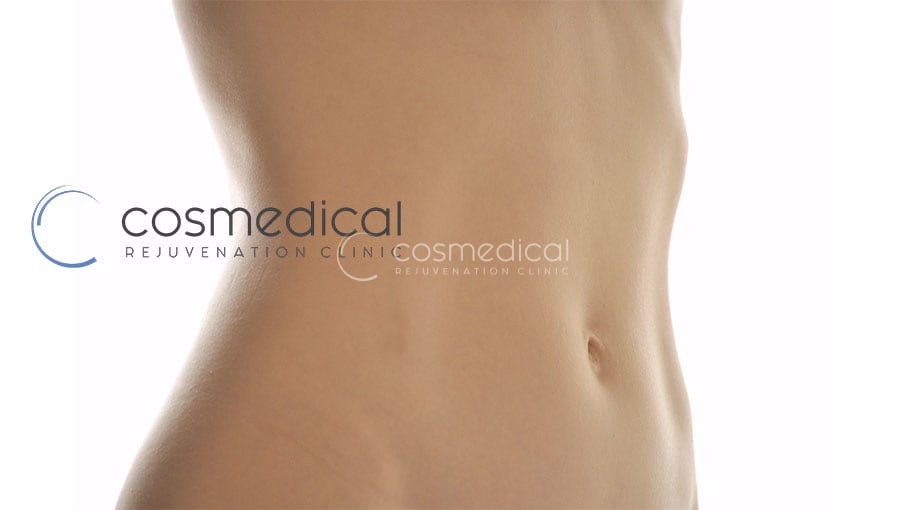Difference Between a Belt Lipectomy and an Extended Tummy Tuck?