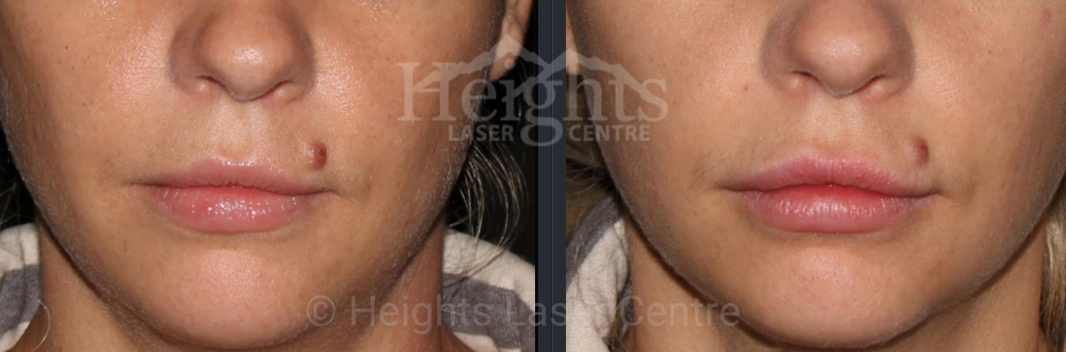 Lip Augmentation Vancouver Superior Results Doctor Injections