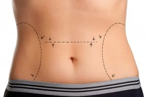 How to Maintain the Results of a Tummy Tuck