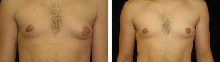 Gynecomastia-case-1-front Before and After Male Breast Reduction Tennessee