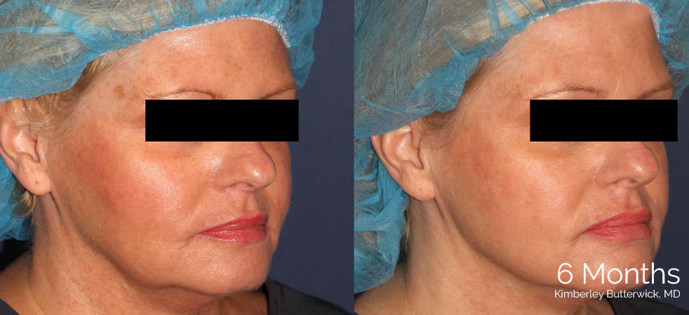 Before and after InstaLift thread lift toronto