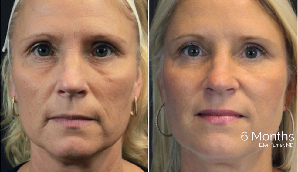 Before and after InstaLift thread lift toronto