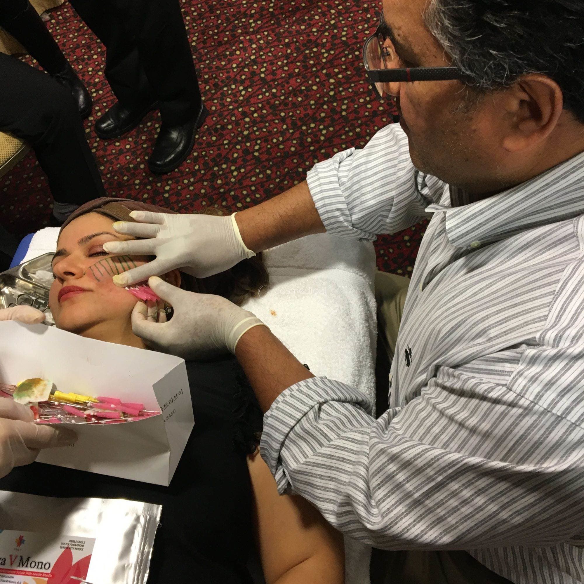IFAAS Threadlift