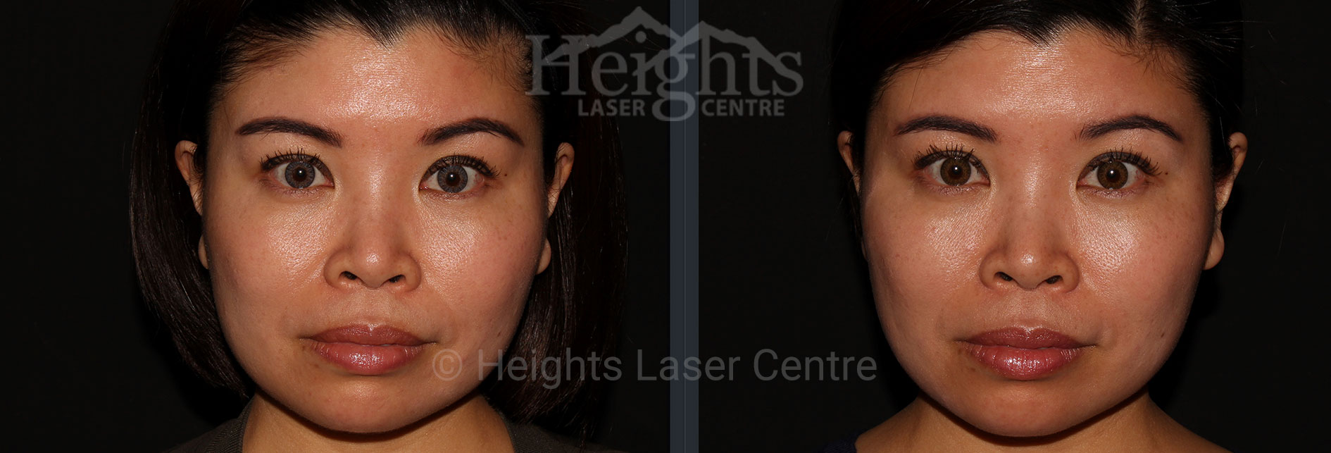 before and after botox vancouver