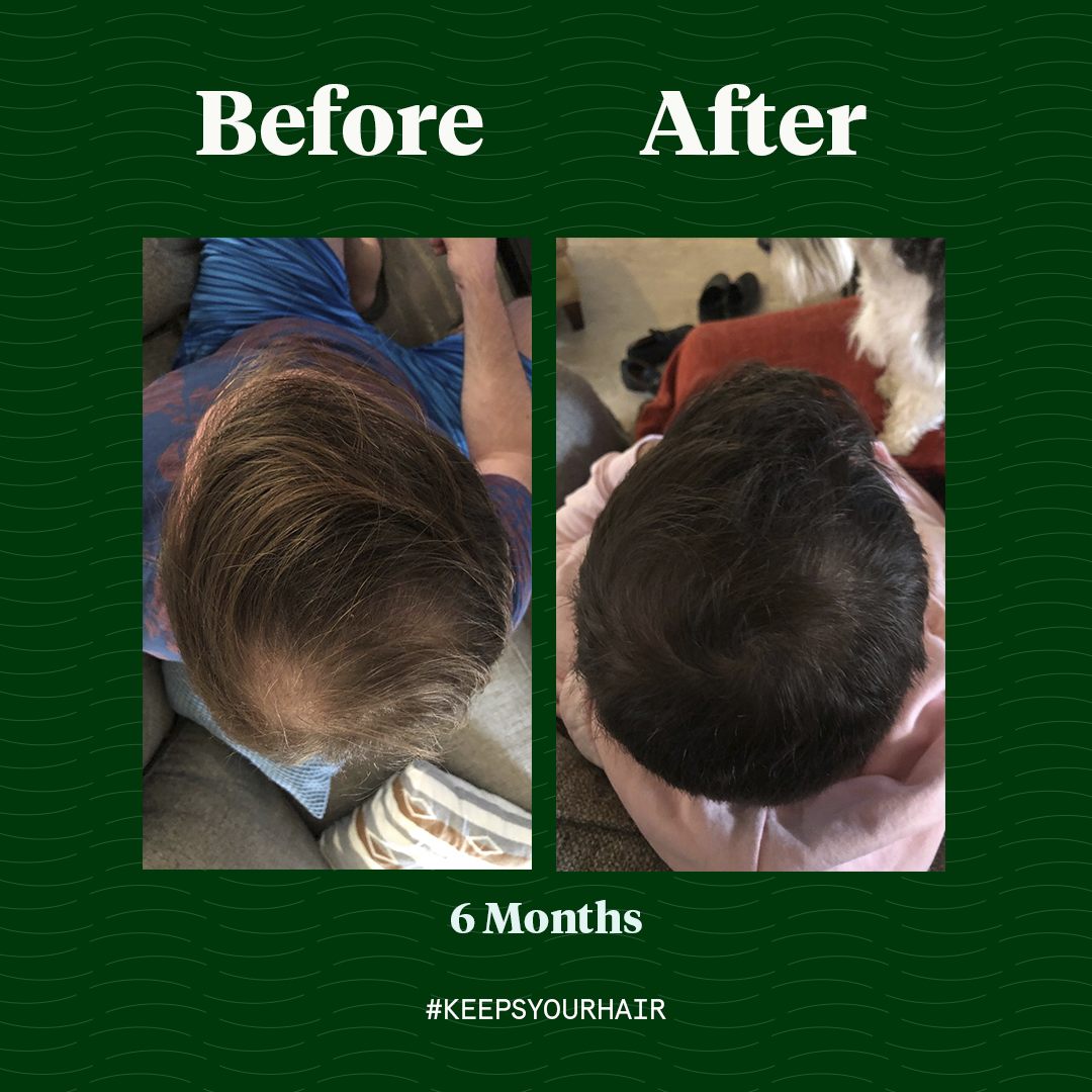 Keeps Hair Loss Treatment Reviews