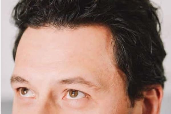 Hair Loss Cure For Men What You Need To Know About Treating Baldness