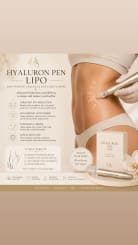 Hyaluron pen lipo(fat REMOVAL)