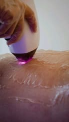 Depilação a laser