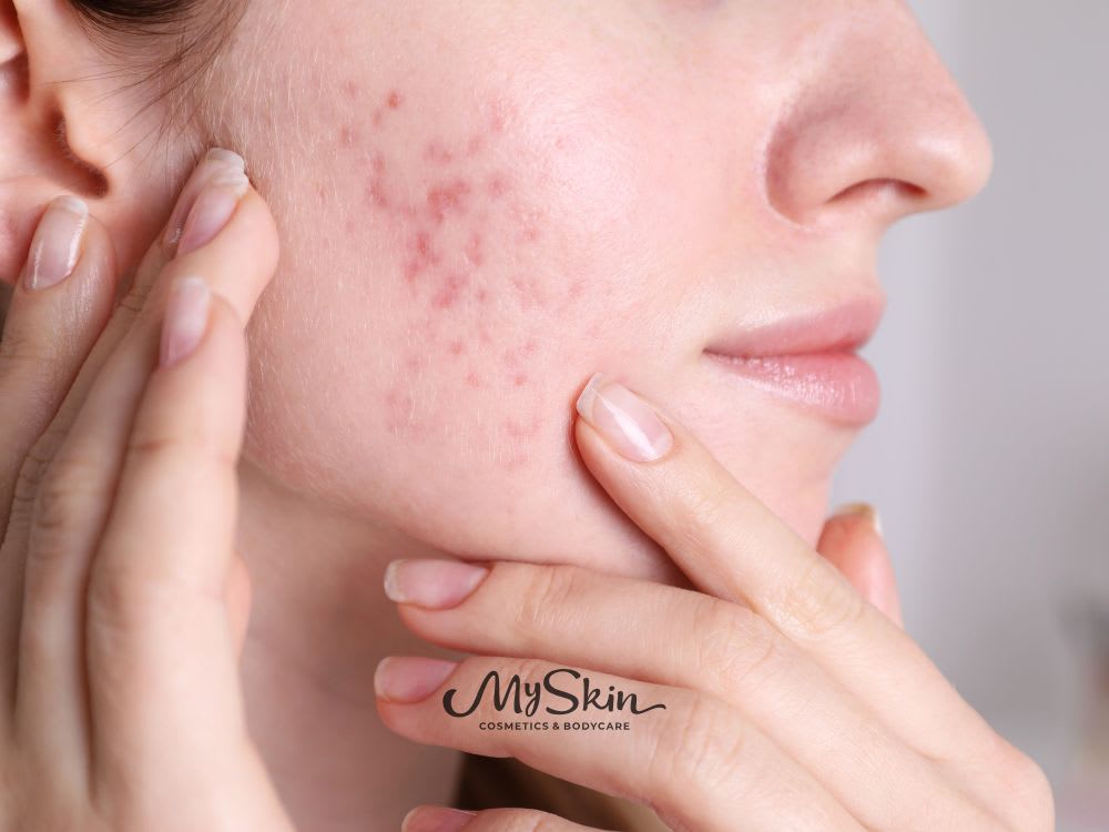 Intenzivní péče o aknózní pleť