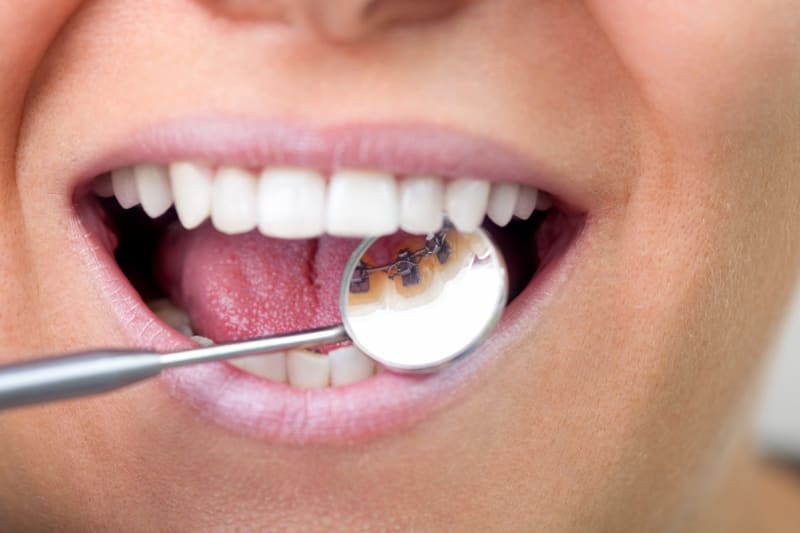 Lingual braces fitted behind the teeth