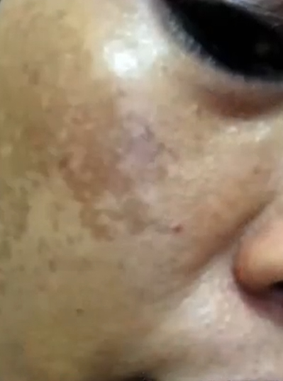 Flek Hitam Hilang Berkat Vibrant Skin Flek Hitam Vibrant Skin
