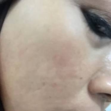 vibrant skin Flek hitam Flek hitam vibrant skin