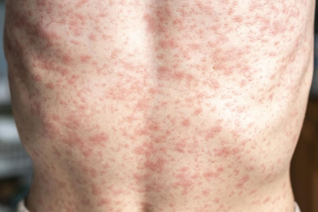 U.S. Measles Cases Hit a 35-Year High as Outbreaks Keep Spreading