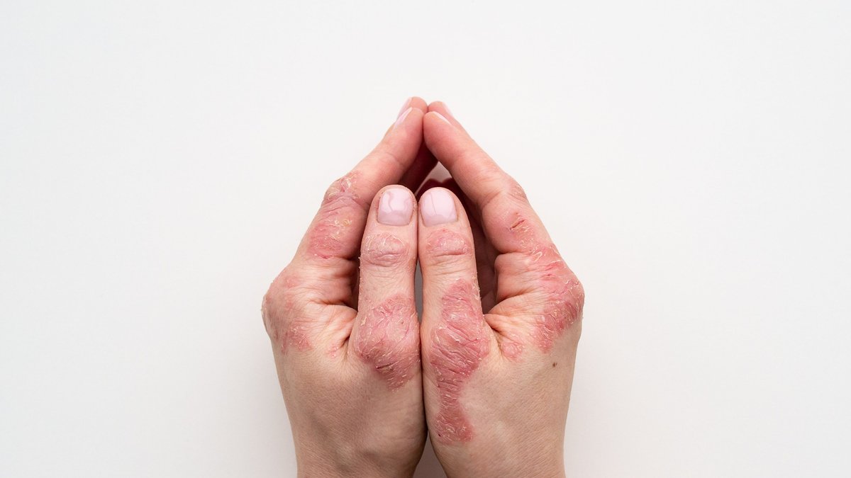 New three-stage framework targets early arthritis detection New three-stage framework targets early arthritis detection - arthritis detection