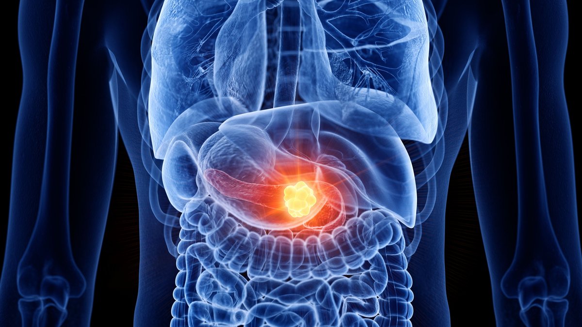FDA approves first-of-its-kind therapy for metastatic pancreatic cancer FDA approves first-of-its-kind therapy for metastatic pancreatic cancer - pancreatic cancer therapy