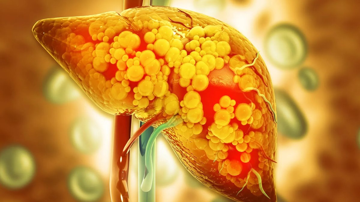 Keto Diet Reduces Liver Fat by 67% - keto diet liver fat