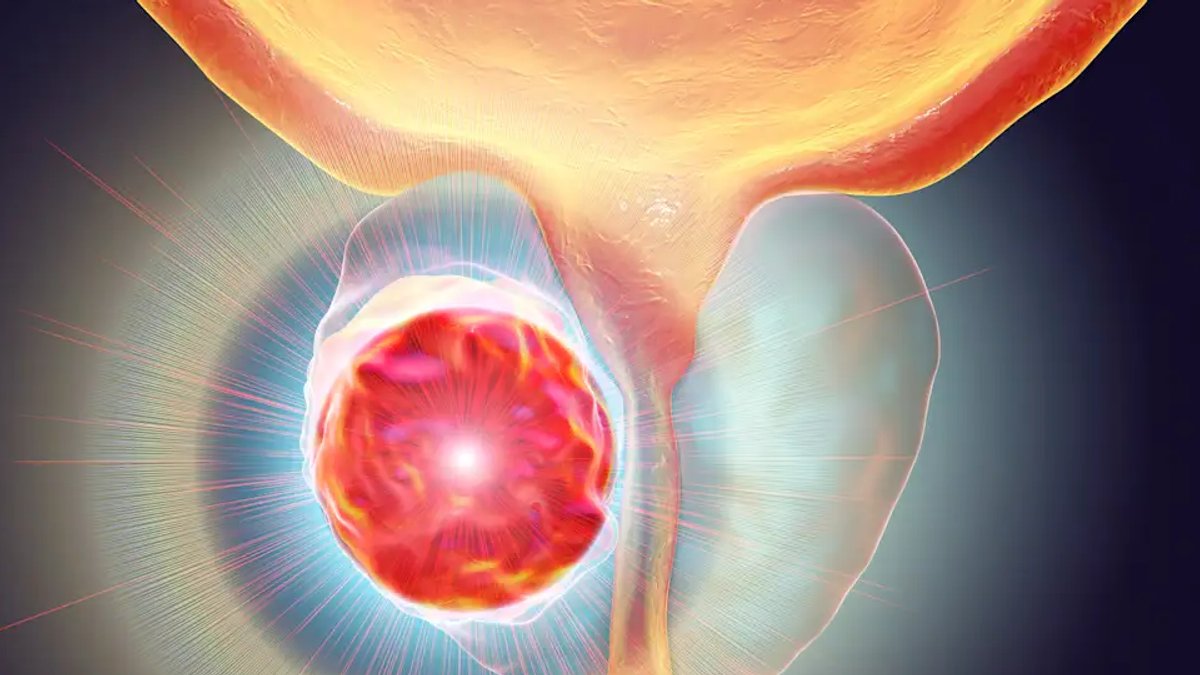 Drug Before Therapy Improves High-Risk Prostate Cancer Outcomes Drug Before Therapy Improves High-Risk Prostate Cancer Outcomes - prostate cancer