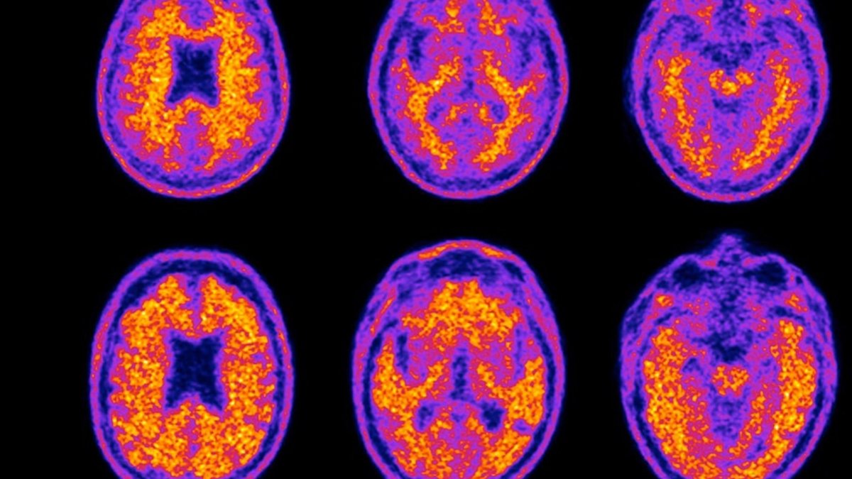 How Lifestyle Choices Can Slow Dementia - dementia prevention