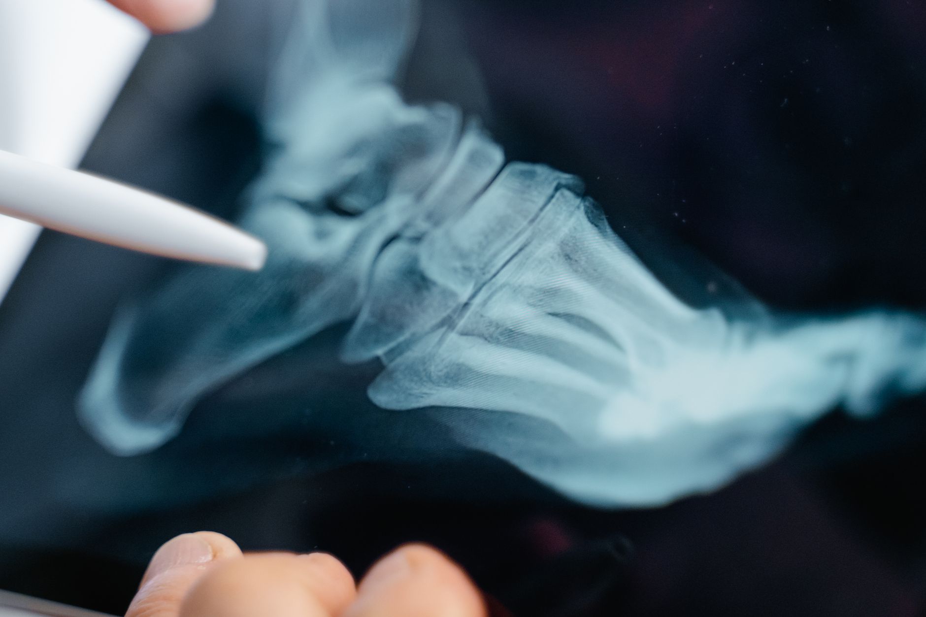 What You Need to Know About Neuroma