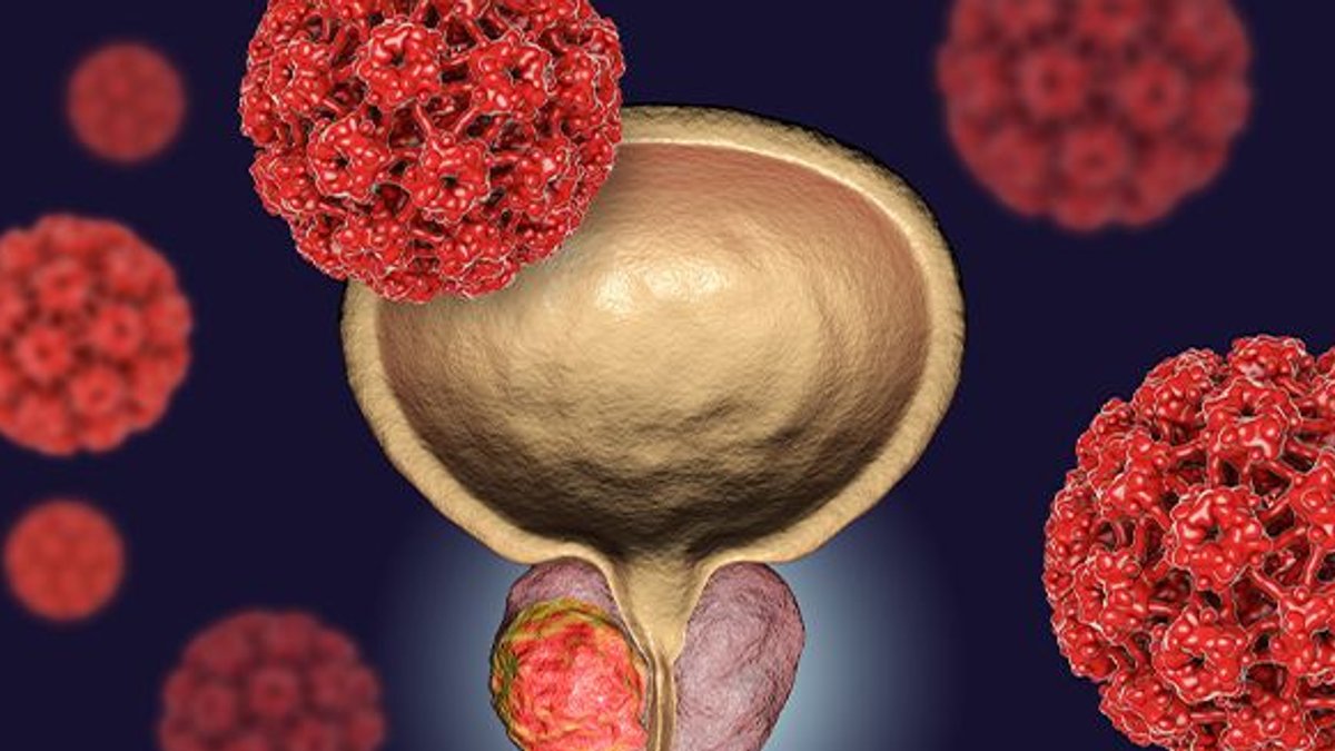 Prostate Cancer Treatment Sees Major Advances - prostate cancer