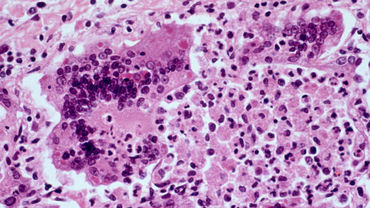 U.S. Measles Outbreak Worst Since 1991, Sparks Debate - measles outbreak
