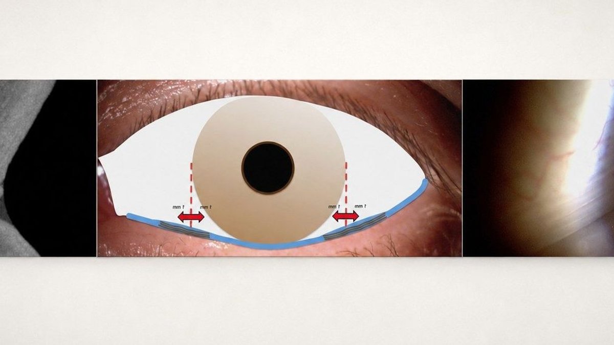 Study Reveals Observation Position Affects LIPCOF Grading in Dry Eye Study Reveals Observation Position Affects LIPCOF Grading in Dry Eye - lipcof grading