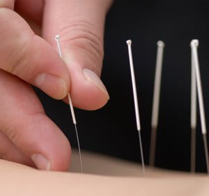 Acupuncture by Peng Jiang, PharmD, LAC - Chinese Acupuncture Center of Ohio, LLC