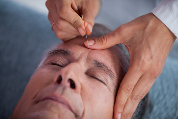 A man closes his eyes and gets acupuncture treatment on his forehead