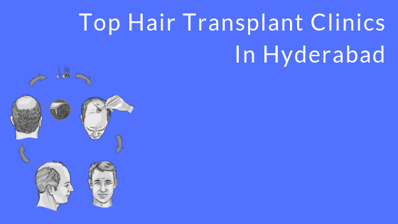 Top Hair Transplant Clinics In Hyderabad - TrueCare Surgicals Top Hair Transplant Clinics In Hyderabad - TrueCare Surgicals