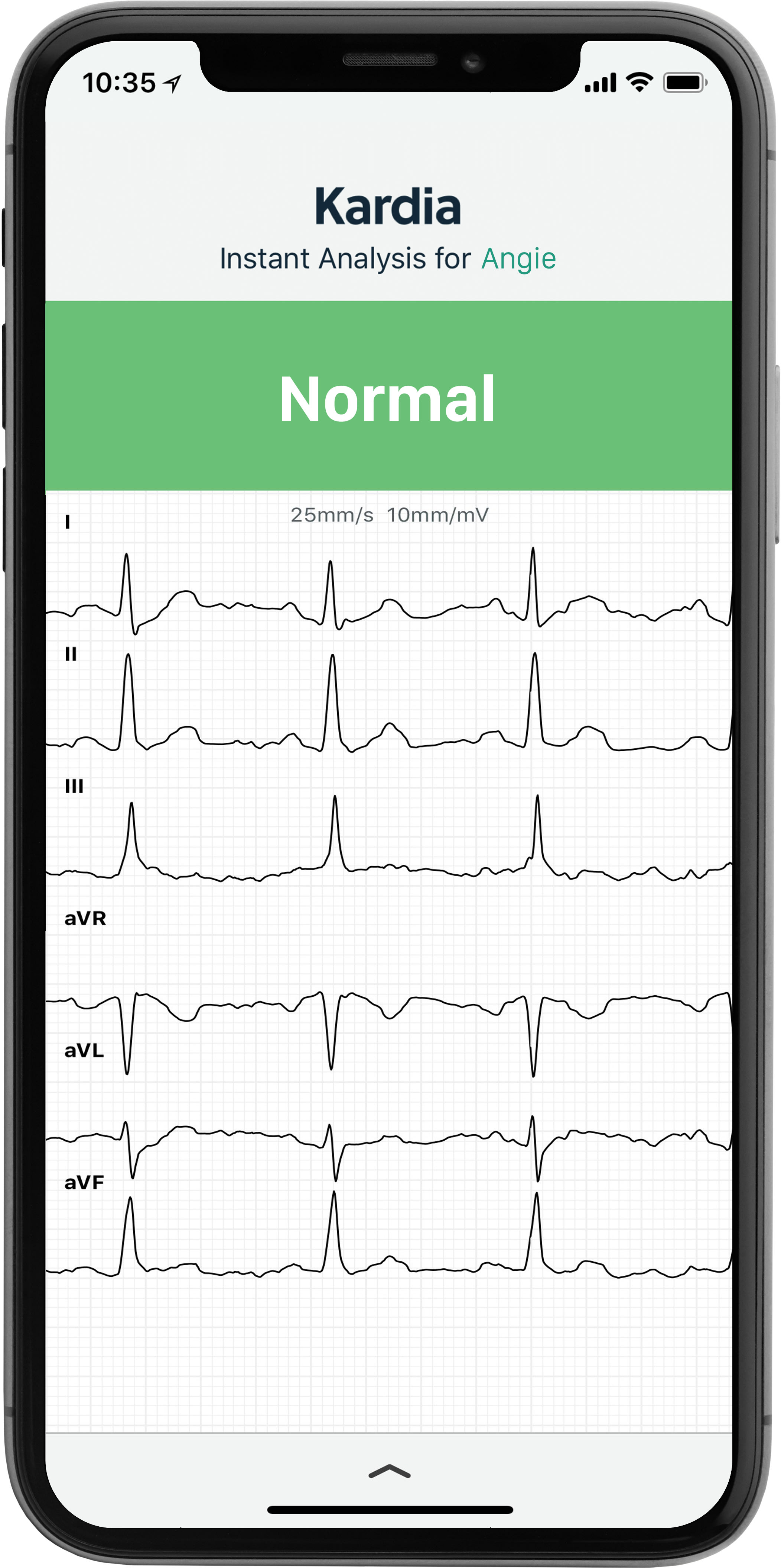 AliveCor KardiaMobile 6L Personal EKG device