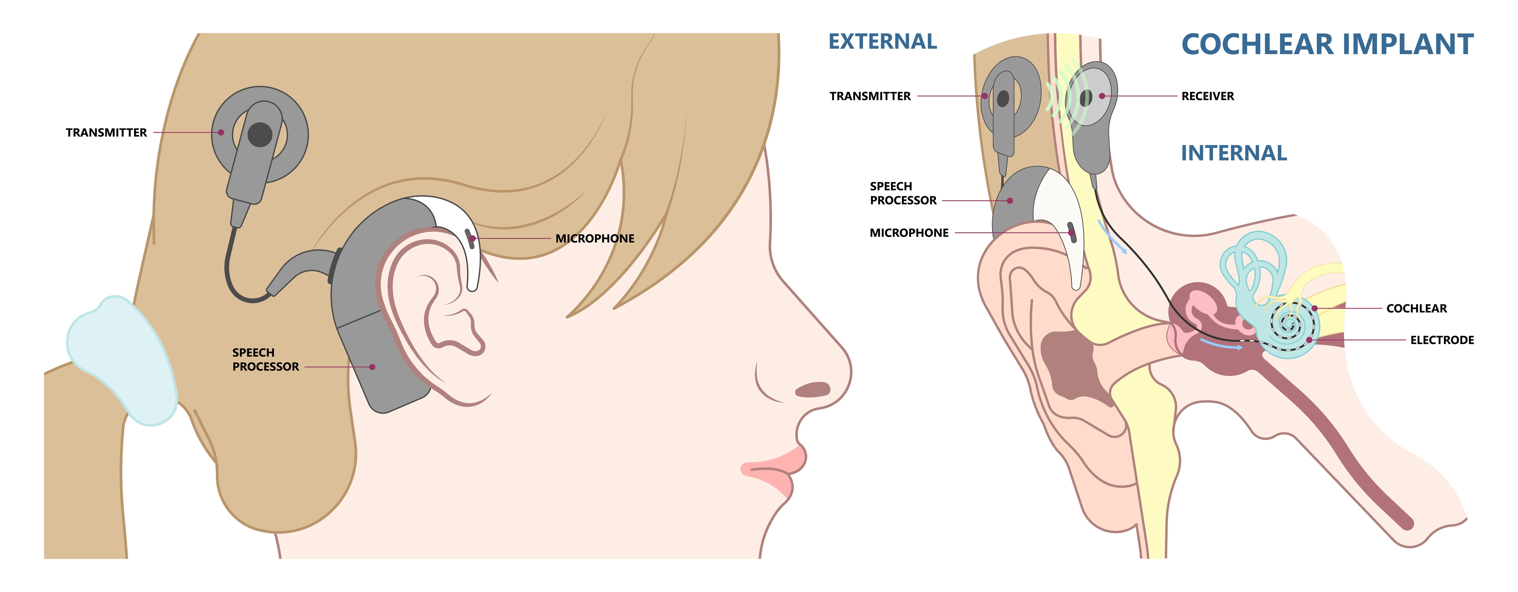 Figure 3: A representation of a typical cochlear implant. (Source: Pepermpron/stock.adobe.com) A representation of a typical cochlear implant