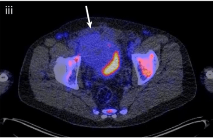 How Imaging Can Drive More Effective Combination Immunotherapy in Oncology