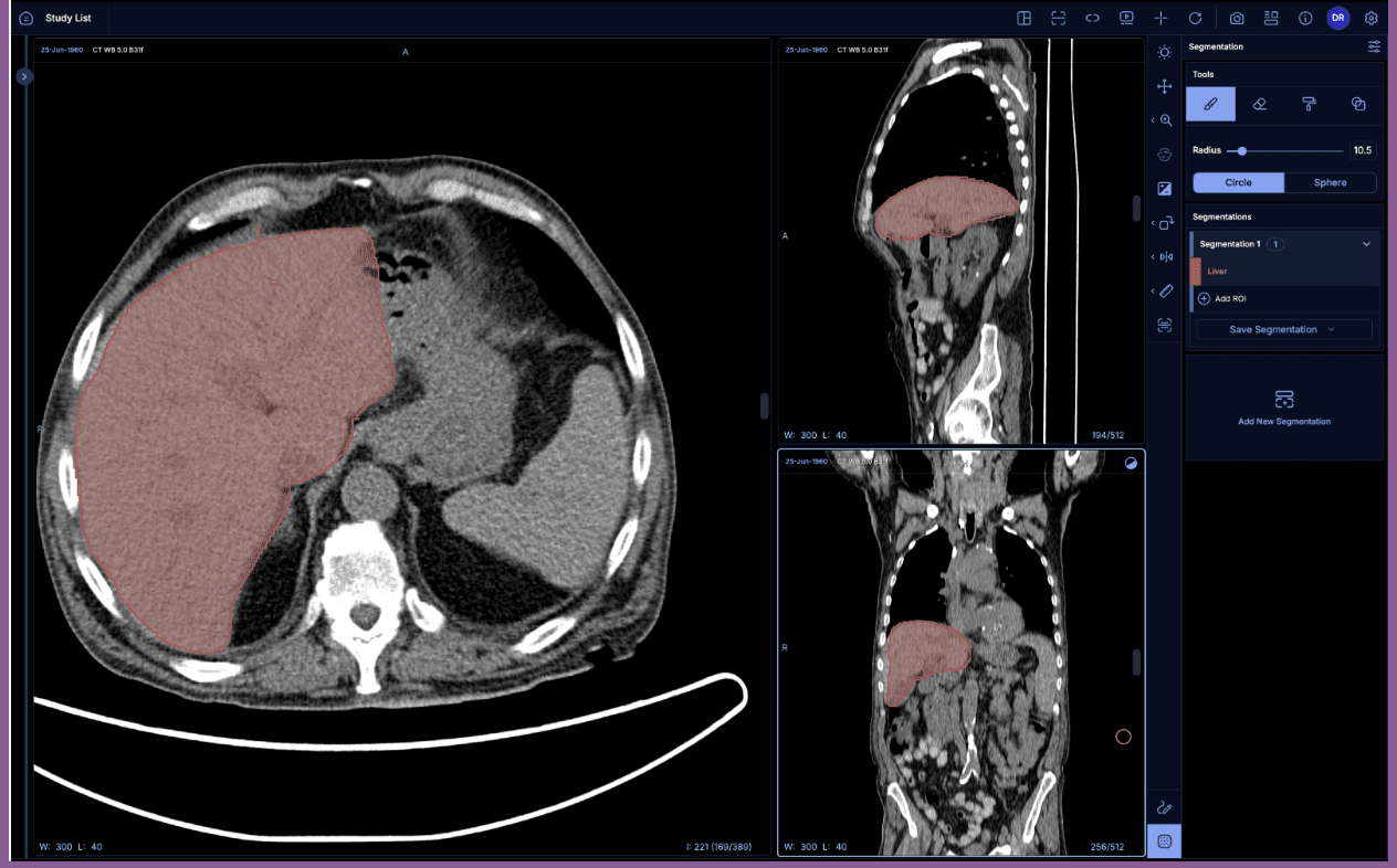 A volumetric segmentation image is shown in three different planes.