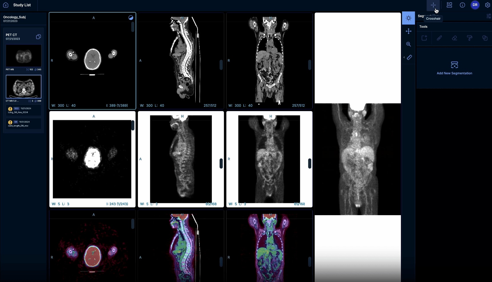Flywheel’s new total metabolic tumor volume (TMTV) view.