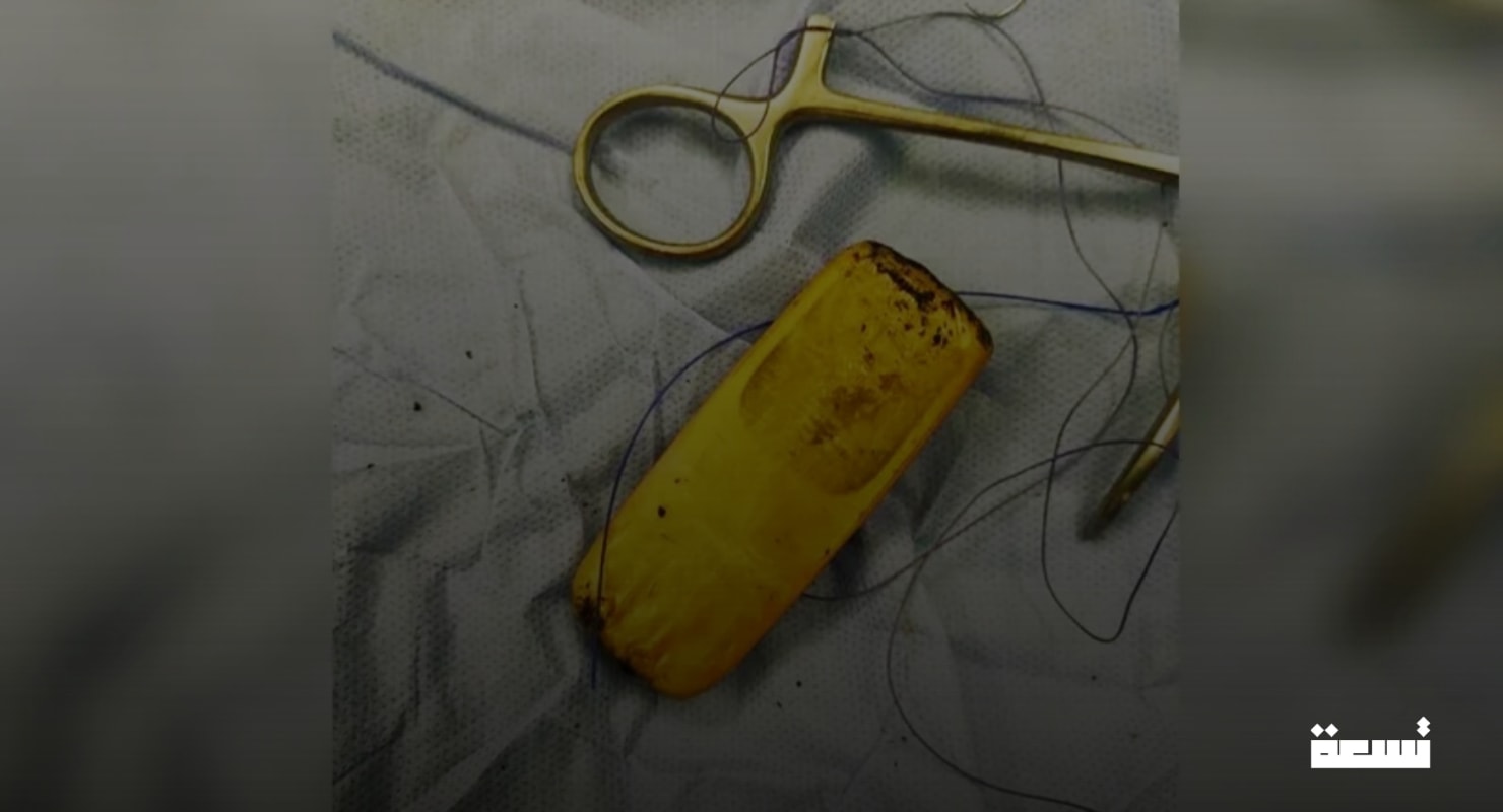 Después de 6 años de dolor... ¡El descubrimiento dentro del abdomen de un paciente sorprende a los médicos!