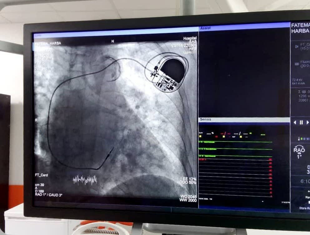 Ma première opération a consisté à installer un stimulateur cardiaque pour deux patientes à l'hôpital Ibn Al Walid dans la province de Homs.