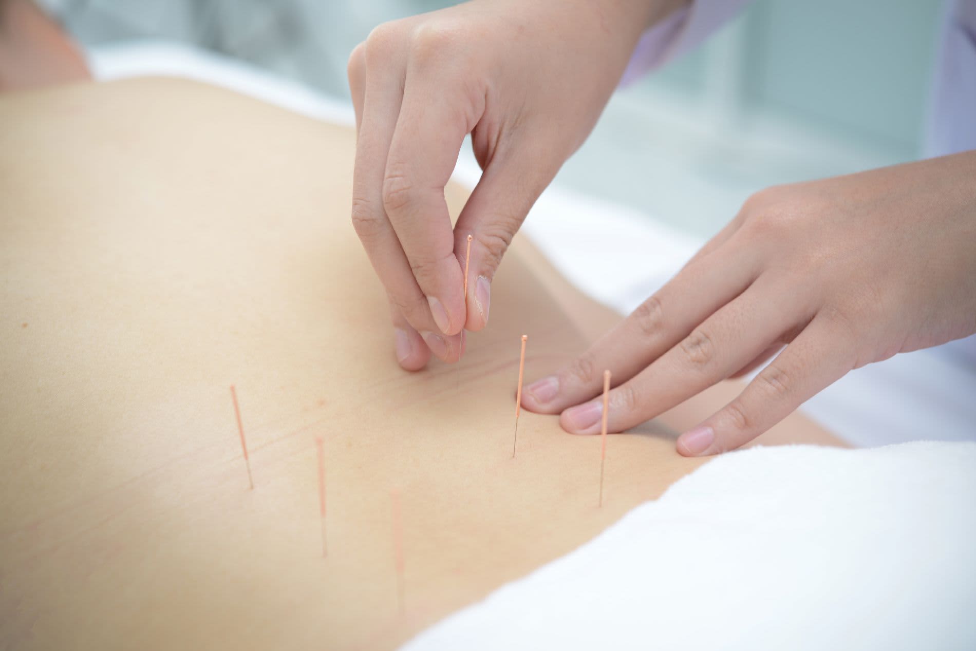 How to Choose an Acupuncturist on the Gold Coast