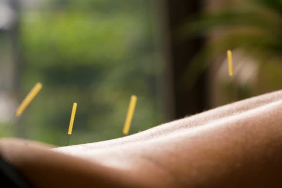 Acupuncture