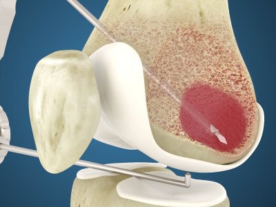 Bespoke 3D Medical Animation