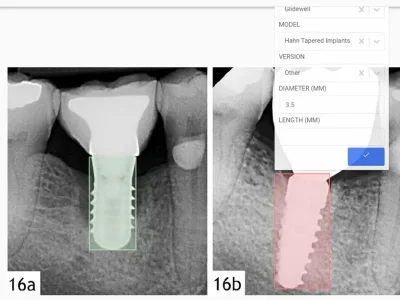 A highly precised annotated dental radiograph | Upwork