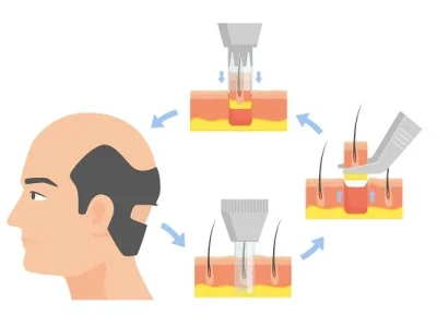 Consultancy service for hair transplantation in Turkey