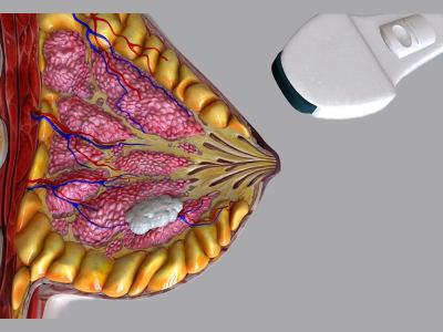 3D Medical Video Animation, 3D Animation, Medical Device, and Surgery