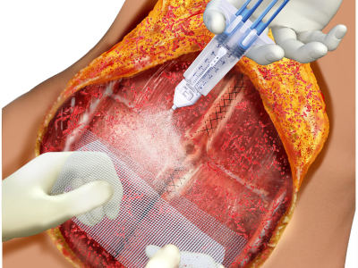 Draw a surgical procedure or anatomical illustration