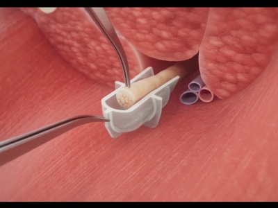 2d or 3d medical animation, medical device, surgery animation anatomy video