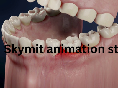 A 3d dental implant animation for patient education, medical animation