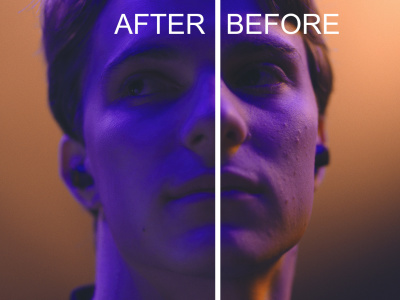 Beauty video retouching, Surgical Blemish removal