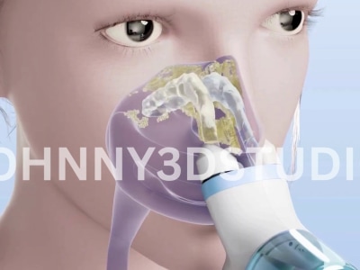 3D medical animation for patient education, Healthcare Video