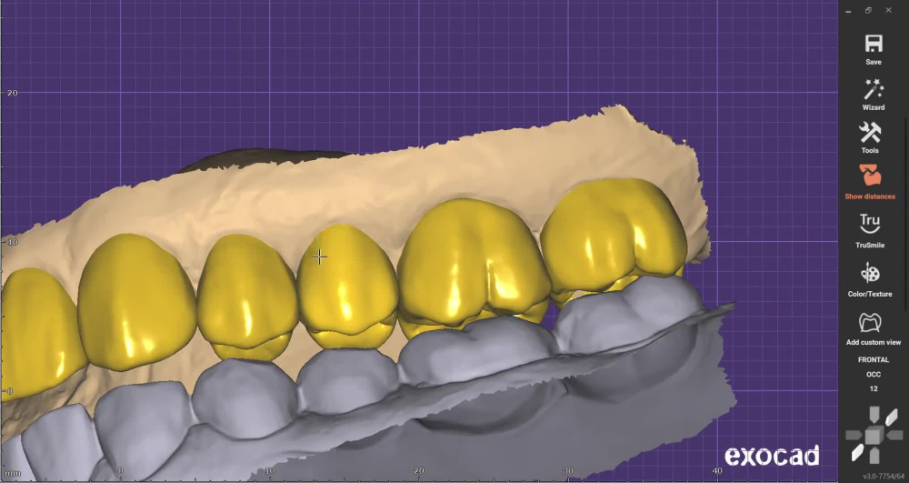 High-Precision Dental CAD/CAM Designs | Crowns, Bridges & DSD mockups ...